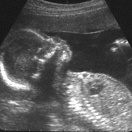Birth Support: Ultrasound Scan Aberdeen